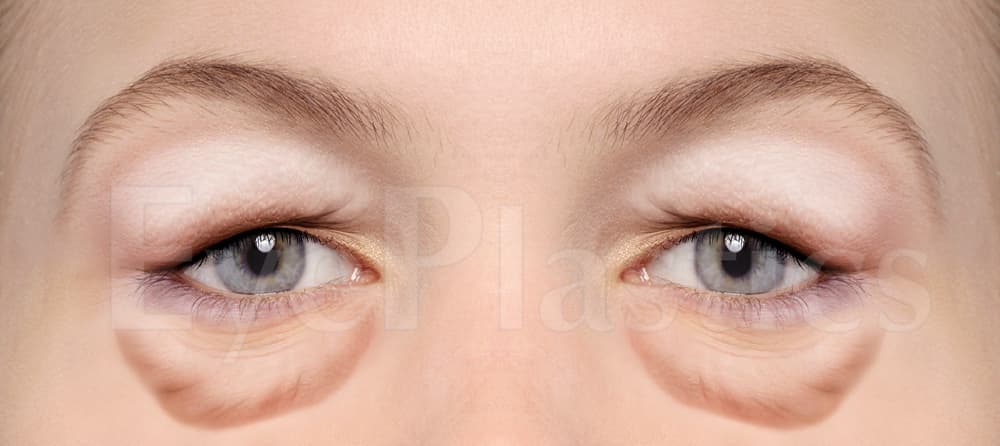 Four-lid blepharoplasty before and after