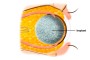 Anophthalmos | oribtal implan | eye anatomy