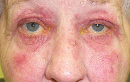 Ocular Rosacea